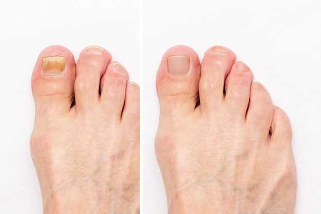 Причины грибка на ногтях ног