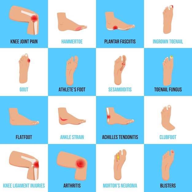Способы облегчения боли при ушибе пальца на ноге