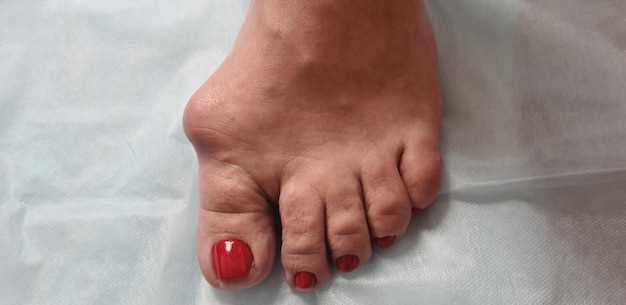 Остеоартрит большого пальца ноги: симптомы и причины