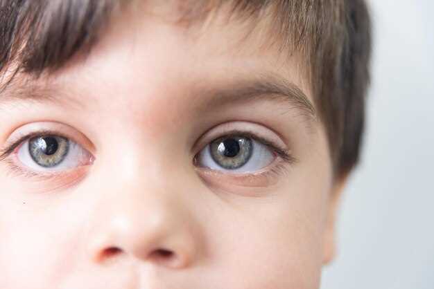 Способы устранения синяков под глазами у ребенка
